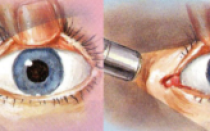 Исследование зрачков и зрачковых реакций