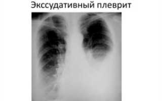 Плеврит экссудативный (парапневмонический)