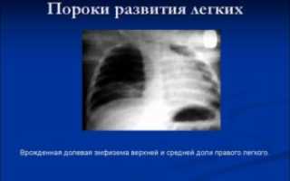 Пороки развития бронхиального дерева и легочной паренхимы