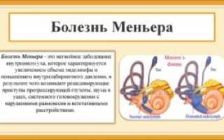 Болезнь Меньера