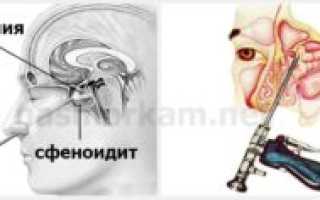 Острое и хроническое воспаление клиновидной пазухи