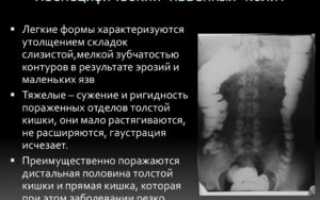 Неспецифический язвенный колит — обзор