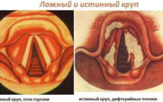 Подскладочный ларингит (ложный круп)