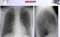 ФЛГ: Обогащён прикорневой лёгочный рисунок