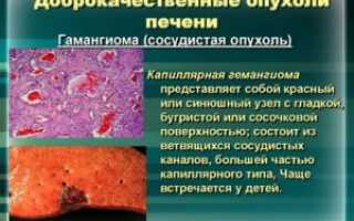 Доброкачественные опухоли печени