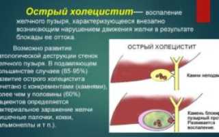 Острый холецистит
