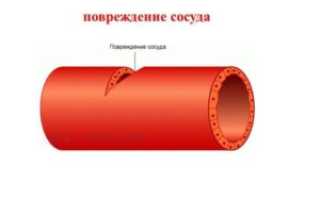 Травмы артерий