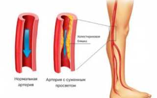 Облитерирующий атеросклероз